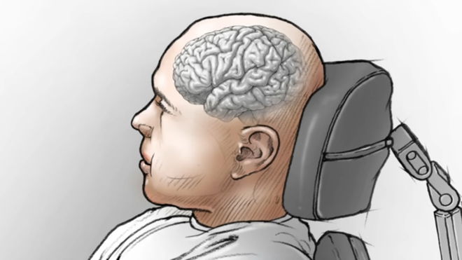 neuroprosthetic device